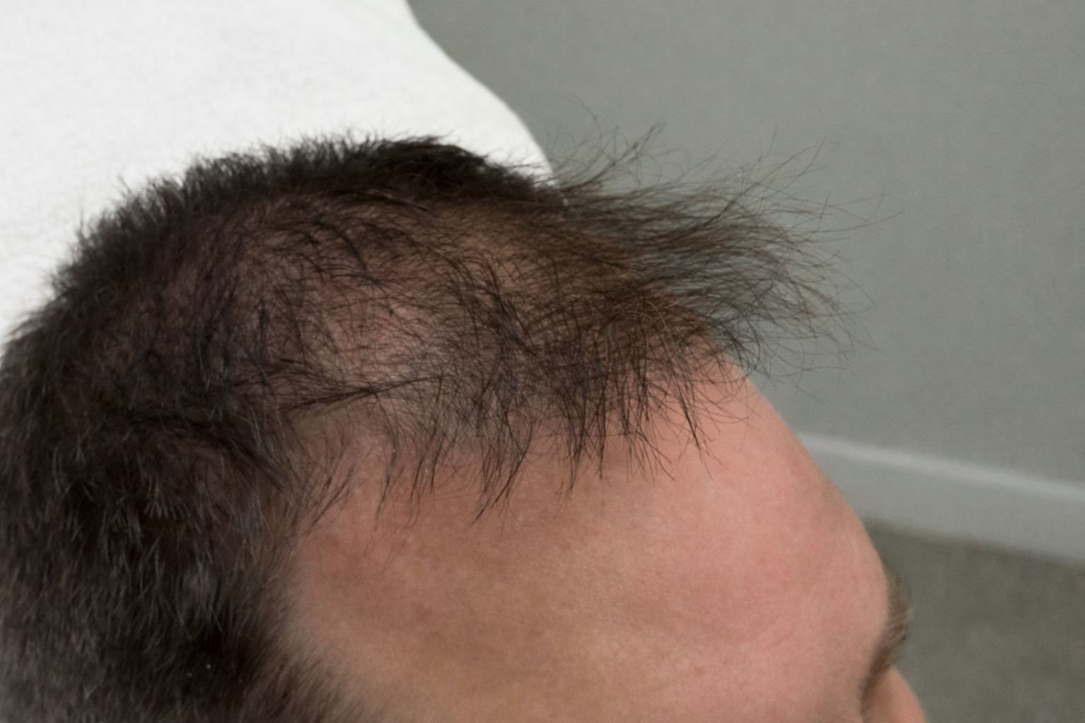 PRP Hair Restoration, Knoxville Before Photo