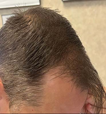 Before Hair Restoration Knoxville Real Client