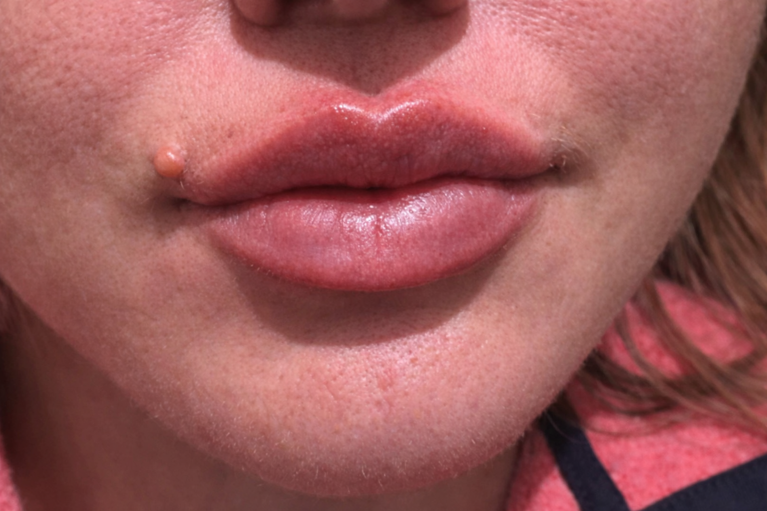 RHA-2 Fillers After Photo