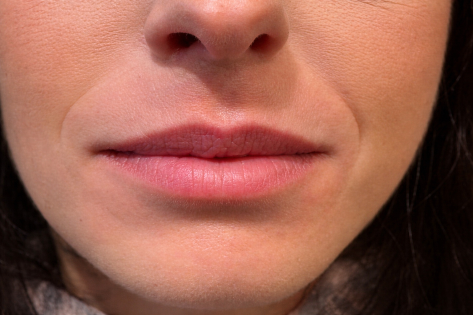 HR Fillers Before Photo