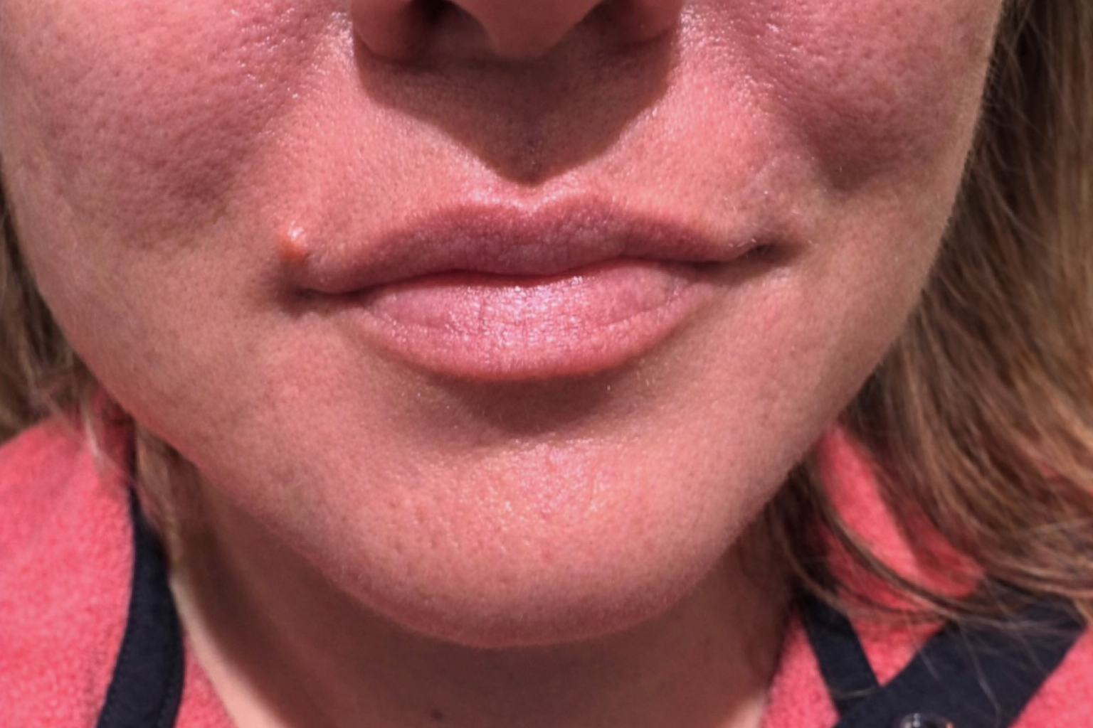 RHA-2 Lip Fillers Before Photo
